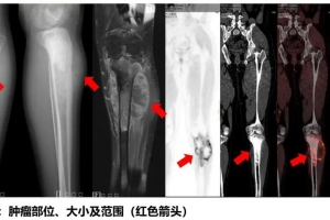 A Case Report - Osteosarcoma Invades The Knee Joint, Liquid Nitrogen For Cryotherapy Treatment Saves The Knee Joint